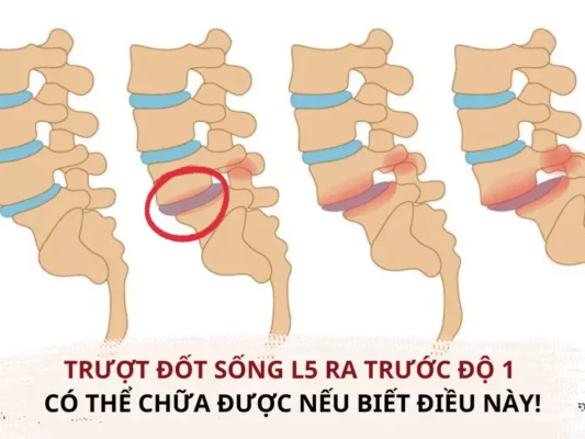 BỆNH TRƯỢT ĐỐT SỐNG NGUYÊN NHÂN VÀ BIỆN PHÁP CHỮA TRIỆT ĐỂ