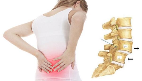 Trượt đốt sống (spondylolisthesis) là tình trạng một đốt sống trong cột sống bị trượt ra khỏi vị trí ban đầu
