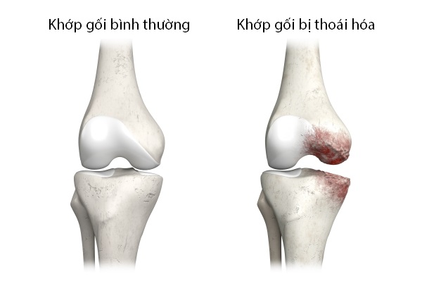 dieu-tri-thoai-hoa-xuong-thai-binh