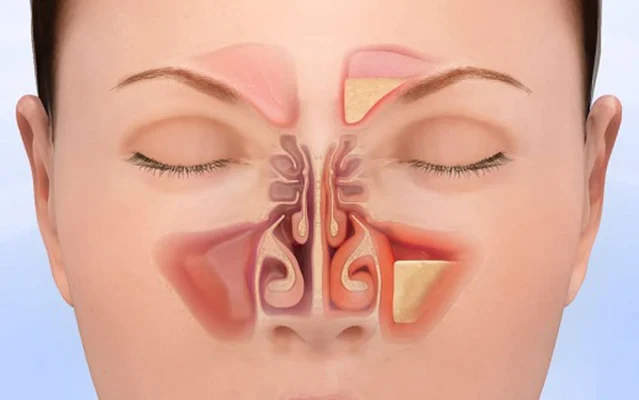 Chữa viêm xoang mũi dị ứng Thái Bình bằng Đông Y– Giải pháp lành tính, hiệu quả lâu dài