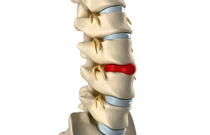 Cách chữa phồng lồi đĩa đệm Thái Bình – Ưu điểm khi điều trị bằng Đông y