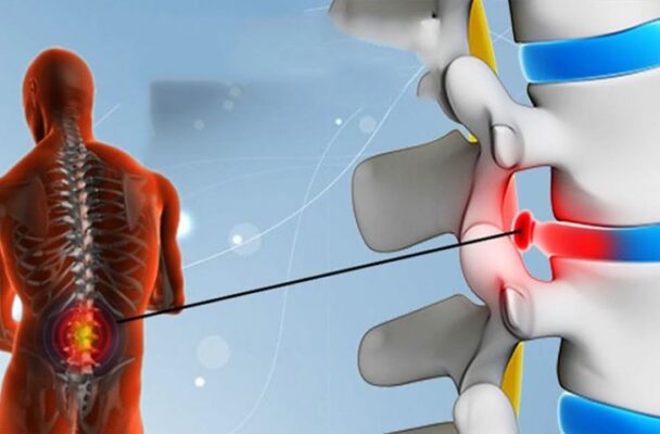 Phồng lồi đĩa đệm là giai đoạn sớm của thoát vị đĩa đệm