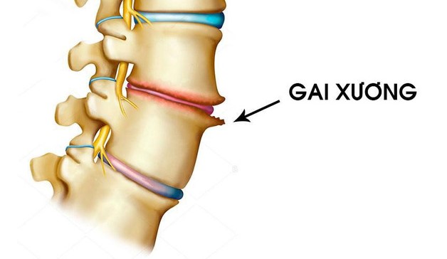 Gai đôi cột sống là gì?