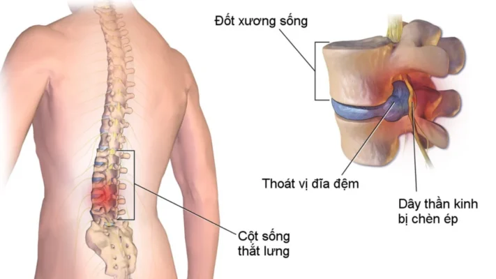 thoat-vi-dia-dem-va-phong-loi-dia-dem