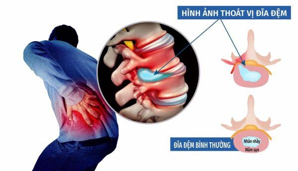 Thoát vị đĩa đệm Thái Bình