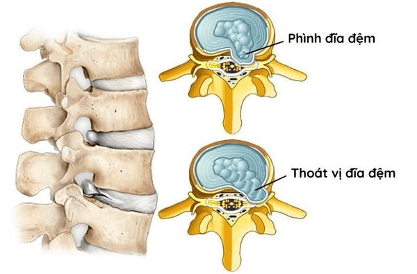 Cách chữa phồng lồi đĩa đệm Thái Bình – Ưu điểm khi điều trị bằng Đông y