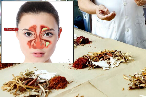 Chữa viêm xoang mũi dị ứng Thái Bình bằng Đông Y– Giải pháp lành tính, hiệu quả lâu dài
